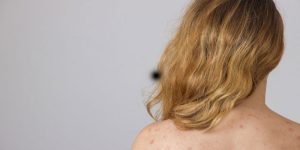 Viêm nang lông ở tuổi dậy thì là gì?