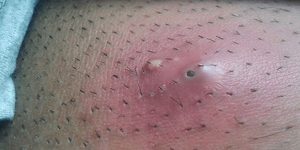 Triệu chứng viêm nang lông vùng kín