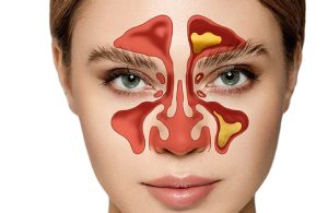Viêm xoang bướm là một dạng viêm xoang xảy ra tại xoang bướm