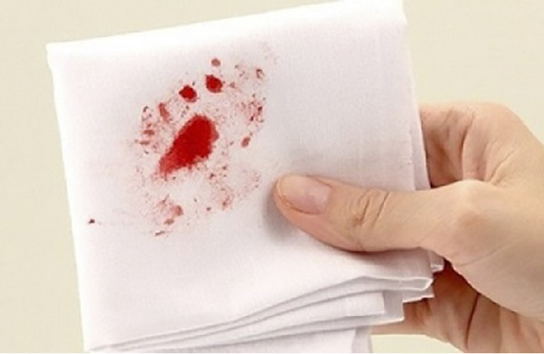 Viêm xoang khạc ra máu là dấu hiệu nhận biết bệnh mãn tính